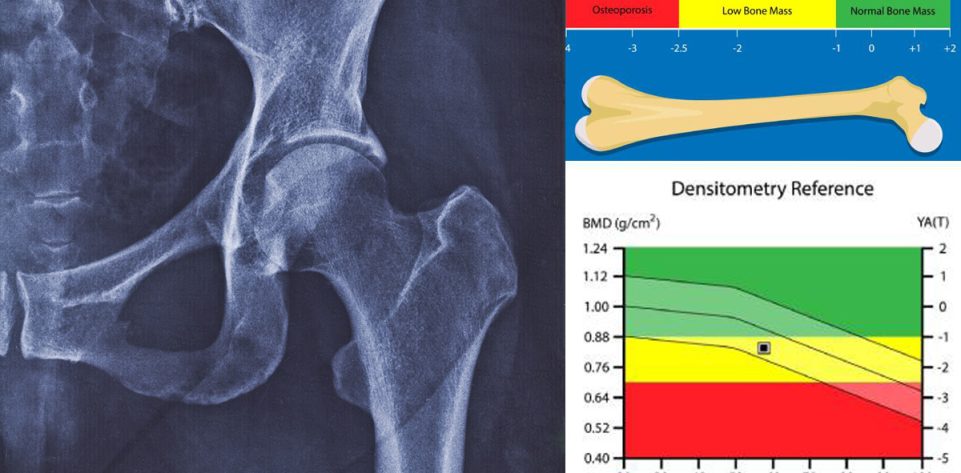 dr-edward-fynn-bone-densitometry-windhoek-north-namibia