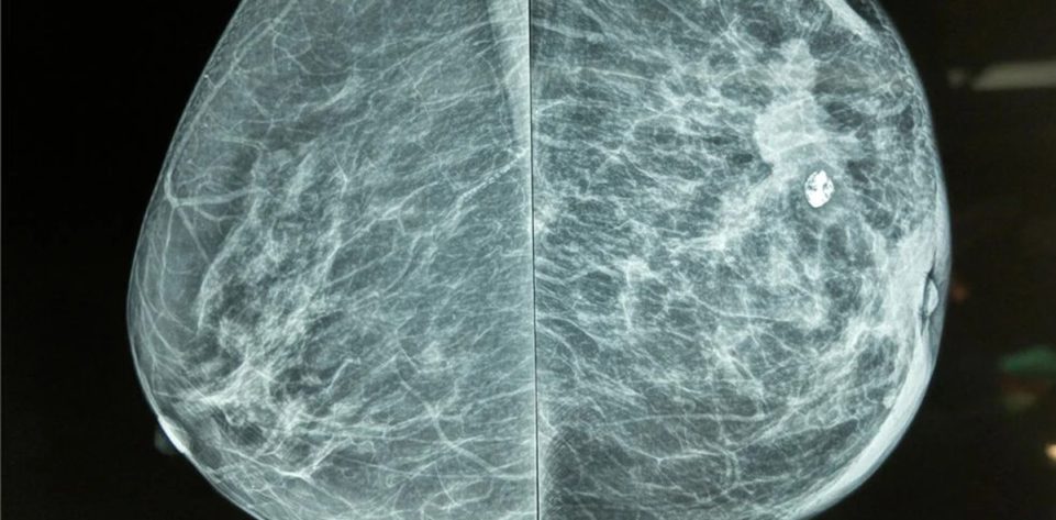 dr-fynn-mammography-windhoek-namibia-life-diagnostic